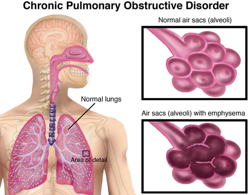 Physical Therapist's Guide to Chronic Obstructive Pulmonary Disease (COPD)