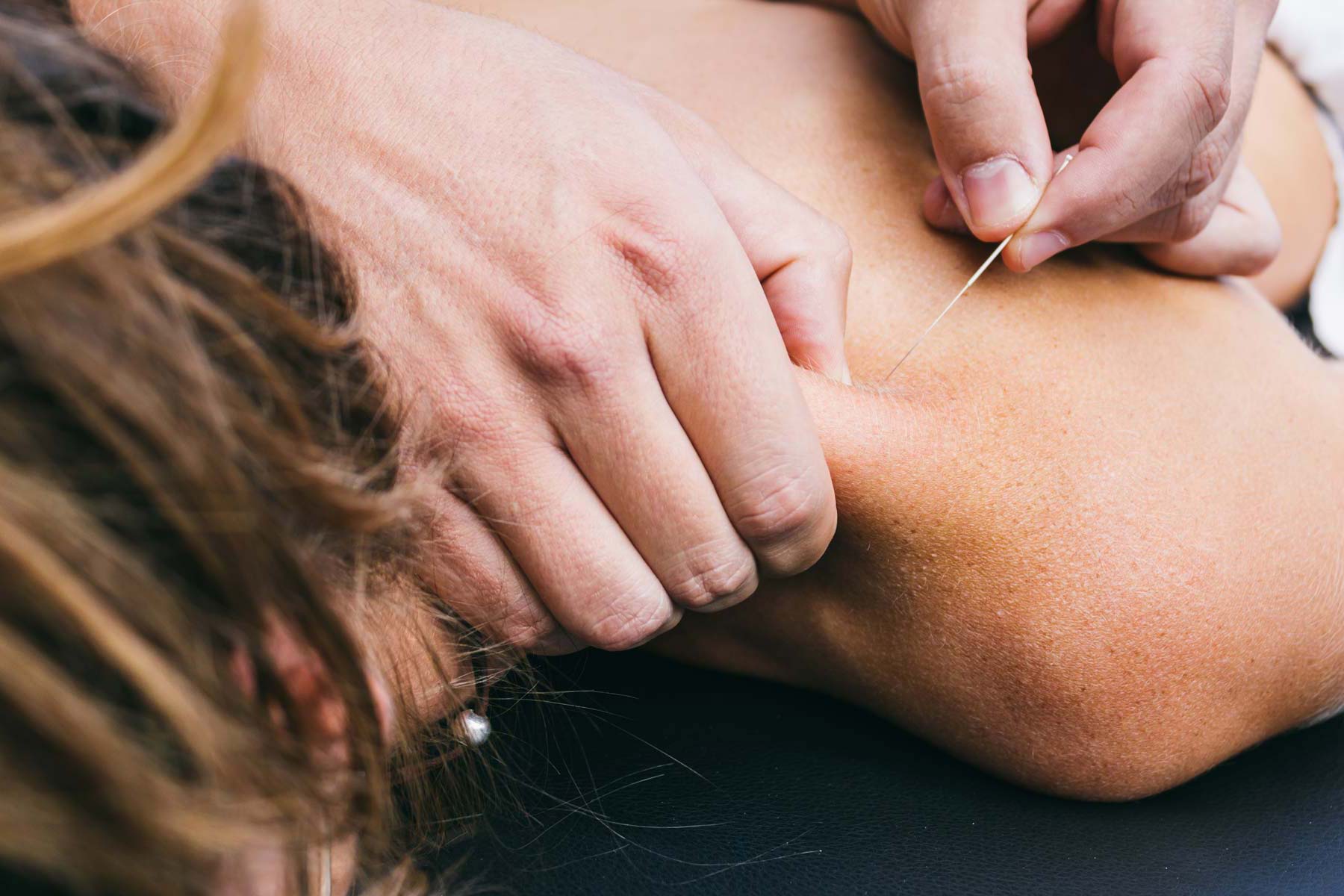 patient getting acupunctured with needle